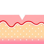 송곳형 여드름 흉터