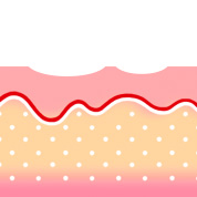 롤링형 여드름 흉터