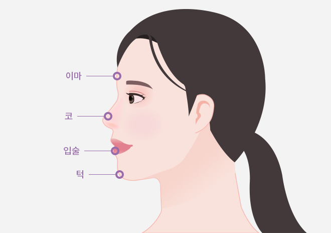 필러 시술부위 (측면)