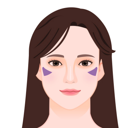 광대 부위 기미