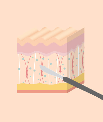 서브시전(진피내절제술)